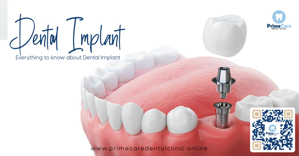 dental implant