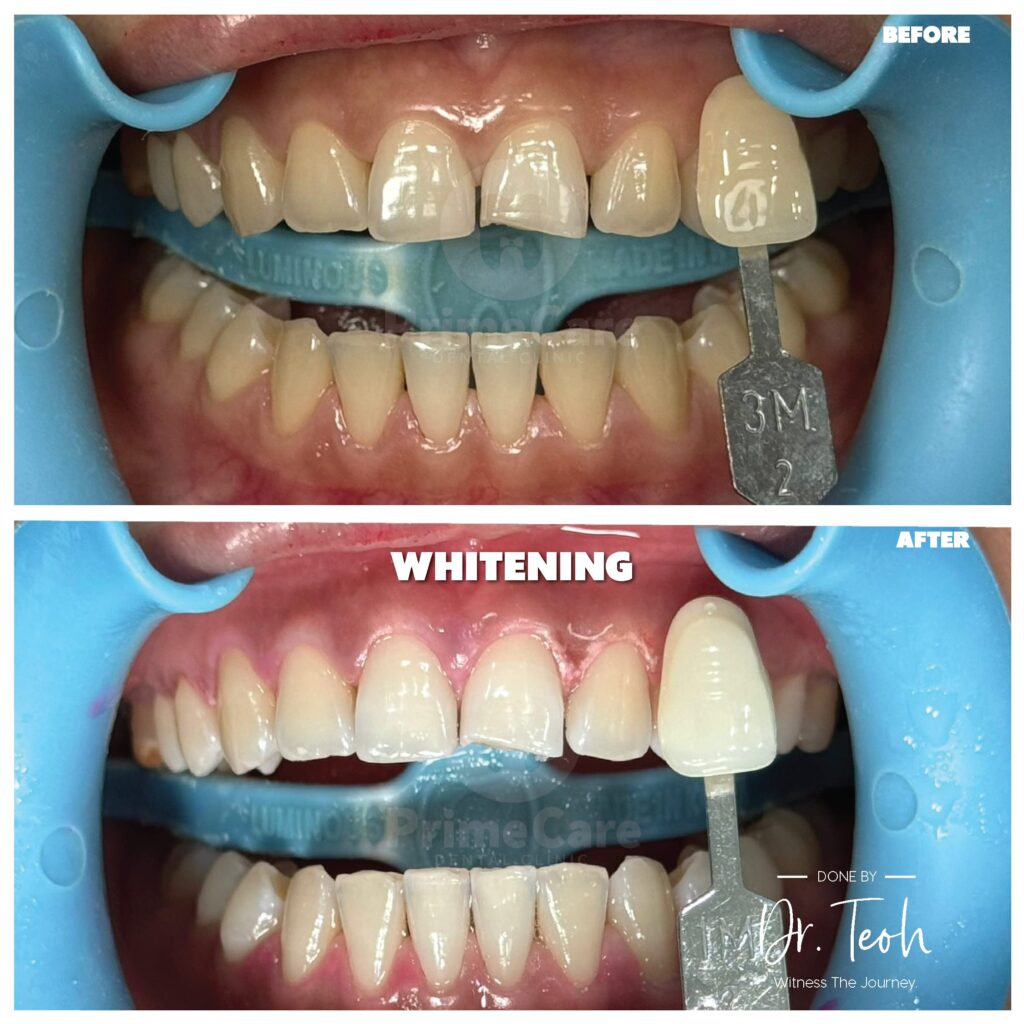 cheap teeth whitening