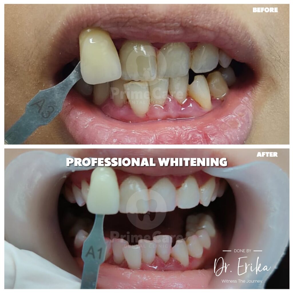 teeth whitening near me