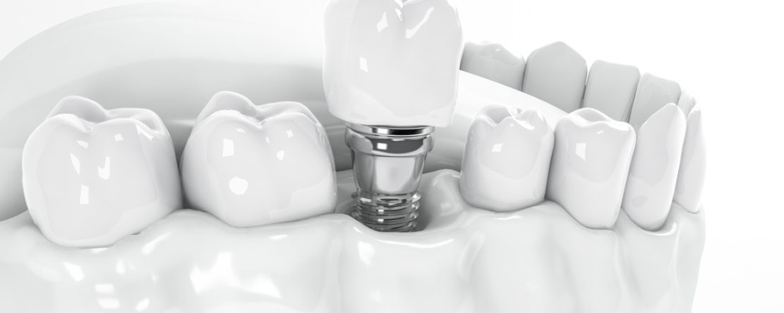 dental implant